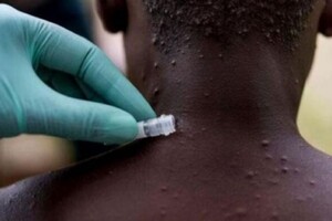 Італієць одночасно заразився ВІЛ, коронавірусом та віспою мавп