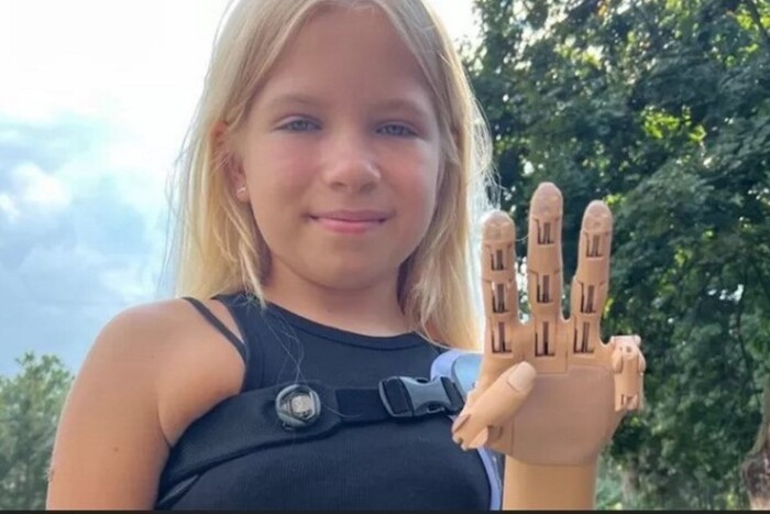 Дівчинка, яка втратила руку в Бучі, отримала унікальний протез (відео)