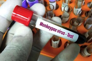 В Україні підтверджено перший випадок зараження мавпячою віспою