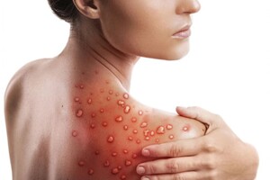 15 вересня в Україні було підтверджено перший випадок зараження мавпячою віспою