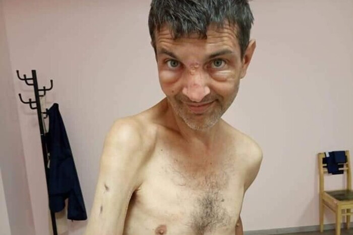 «Цена плена». У освобожденного защитника Мариуполя – страшная травма руки (фото)