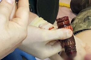 Медики дістали з тіла пораненого воїна бойову частину гранати (фото)