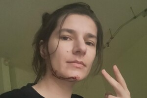 Скло порізало обличчя: під час удару РФ по Харкову була поранена волонтерка Попова (фото)