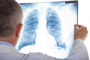 Україна вперше використала штучний інтелект для діагностики туберкульозу