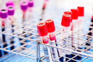 ВІЛ-інфекція – це хронічне захворювання, що виникає внаслідок потрапляння в організм вірусу імунодефіциту людини