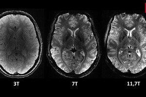 Унікальні зображення людського мозку. У Франції запустили найпотужніший у світі МРТ-сканер (відео)