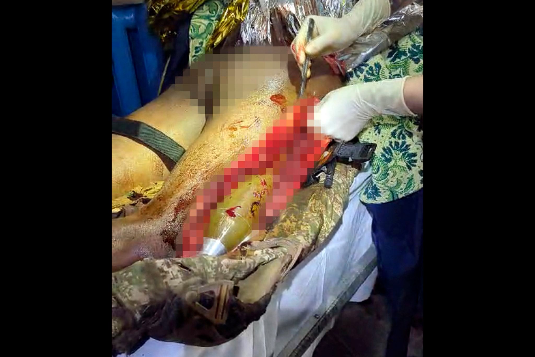 Лікарі дістали із ноги пораненого бійця двокілограмовий боєприпас фото 3