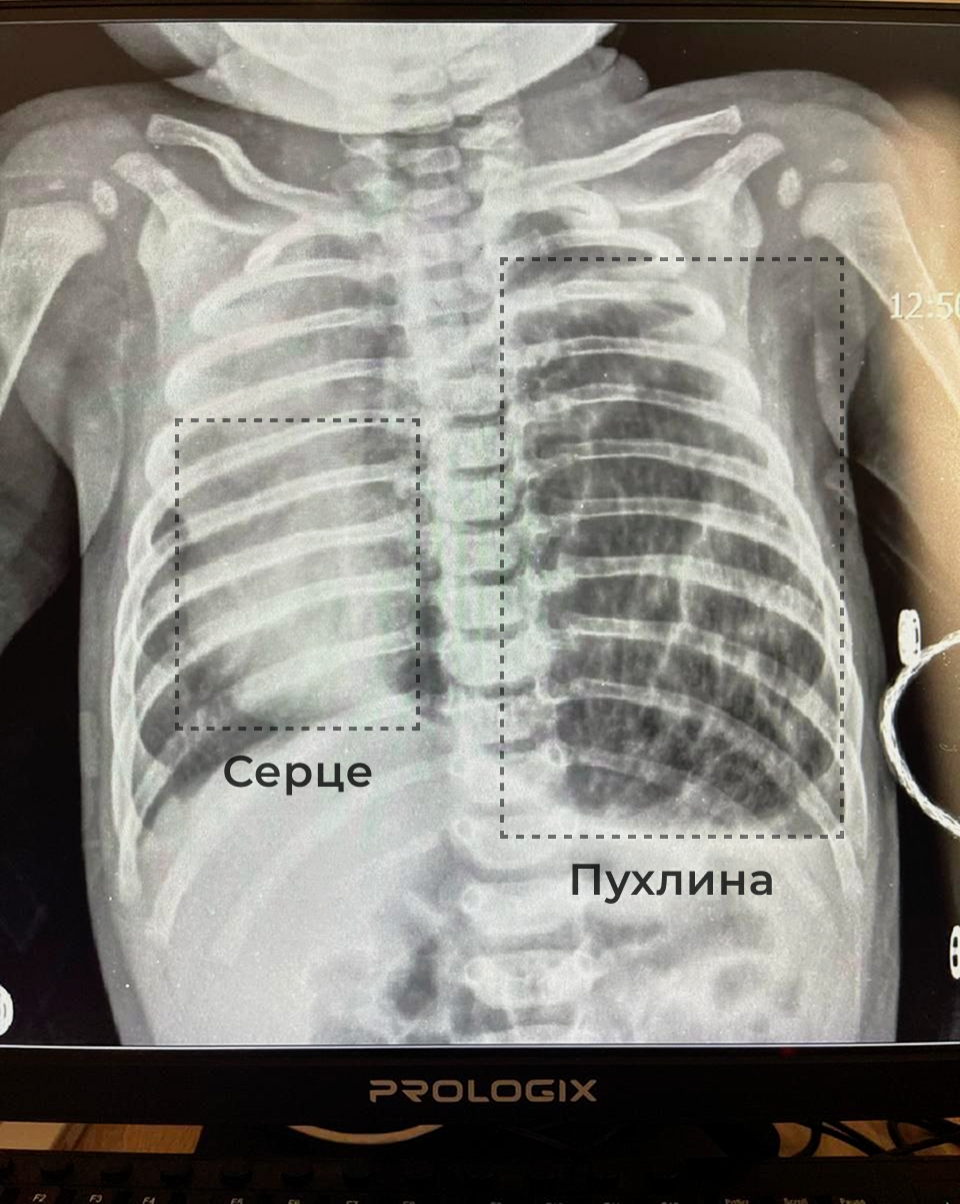 «Пухлина була розміром з долоню». У Львові медики врятували немовля фото 1