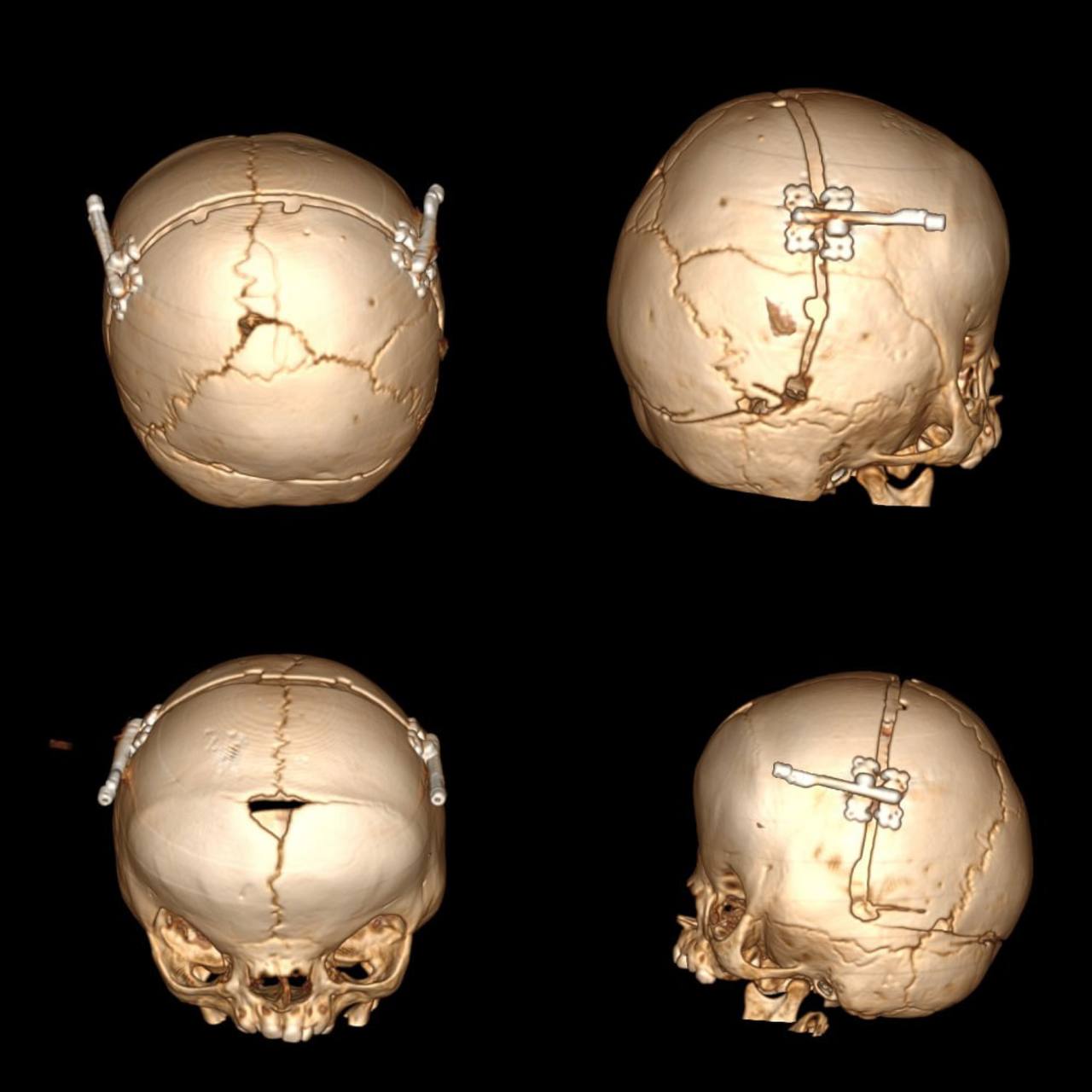 Лікарі провели корекцію форми черепа дівчинці
