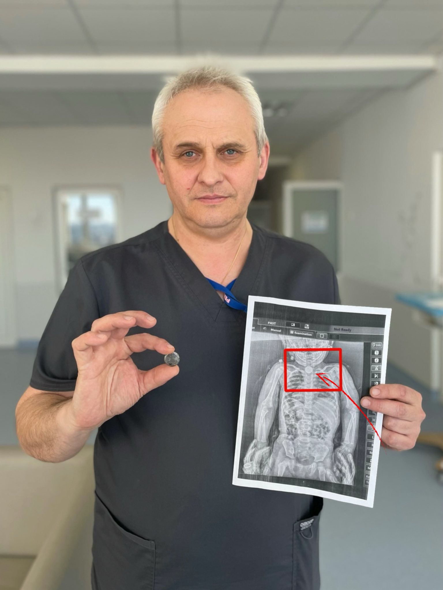 У Львові дворічна дівчинка три місяці жила з батарейкою в стравоході (фото) фото 1