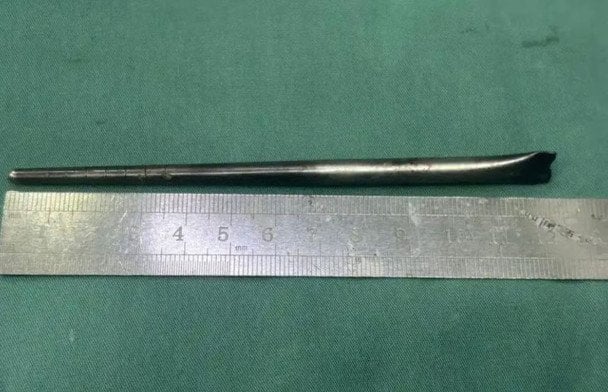 Лікарі видалили з горла пацієнта металеву палицю розміром 12 см