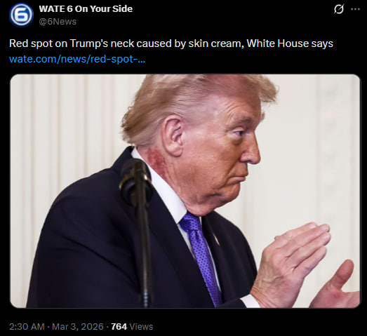 Пляма на шиї Дональда Трампа з’явилася після профілактичного лікування шкіри