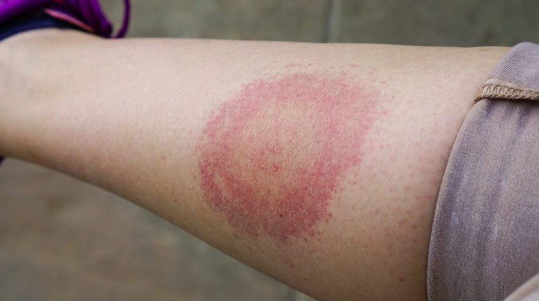 Ізольована мігруюча еритрема