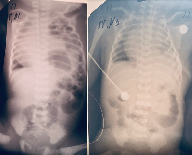 Рентген до та після операції маленького пацієнта. Фото: «Охматдит»