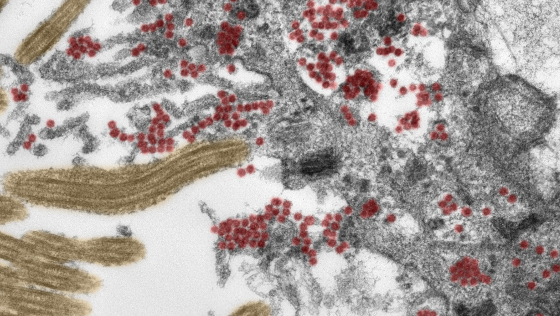 Зображення з електронного мікроскопа показує зріз миготливої клітини в нюховій слизовій. Велика кількість частинок SARS-CoV-2 (червоних) знаходиться як усередині клітини, так і в клітинних процесах