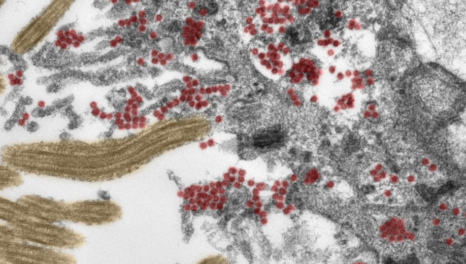 Зображення з електронного мікроскопа показує велику кількість частинок SARS-CoV-2 (червоних) знаходиться всередині тканини носової порожнини