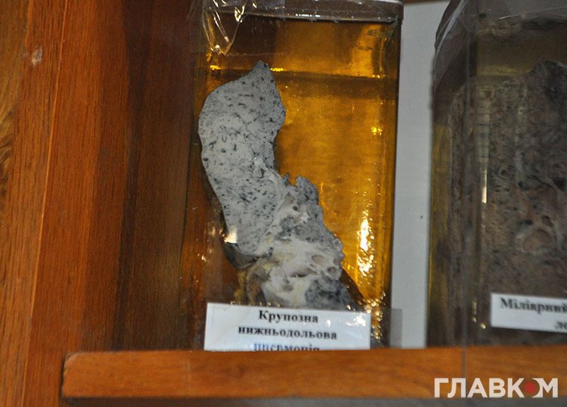 Легеня з пневмонією у міні-музеї внутрішніх органів, що у Хмельницькому обласному патологоанатомічну центрі