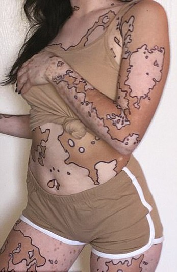 Карта мира на теле: девушка превратила свою болезнь в произведение искусства